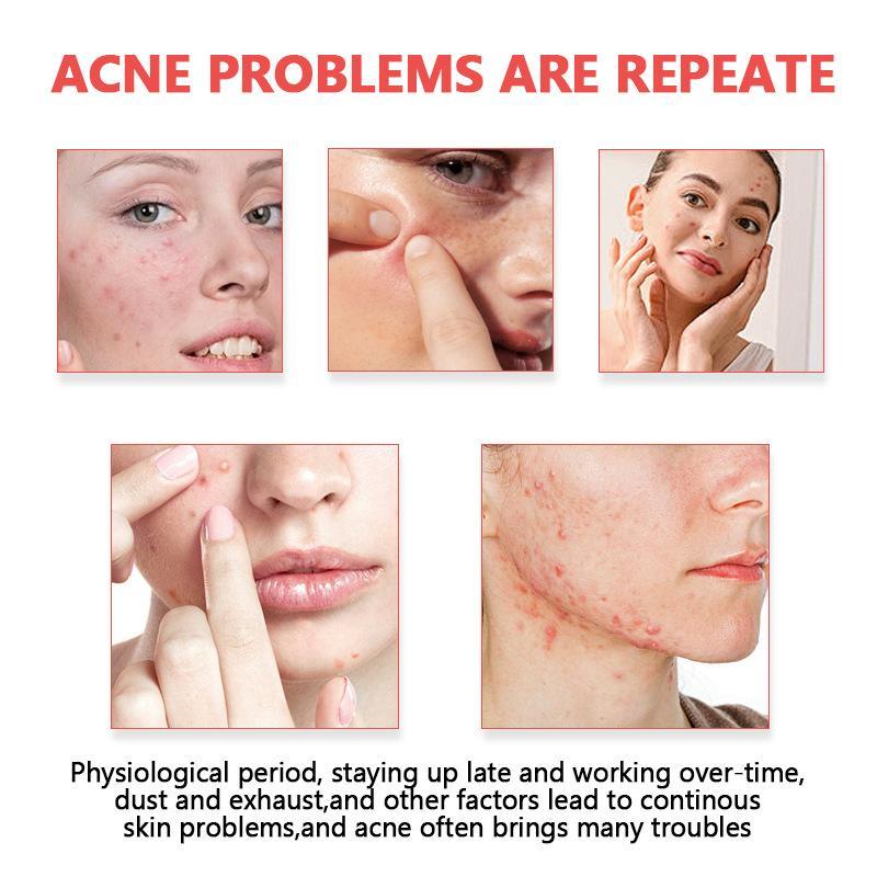 Acne Patches Invisible Hydroco - Skincare Oil Control recension och pris